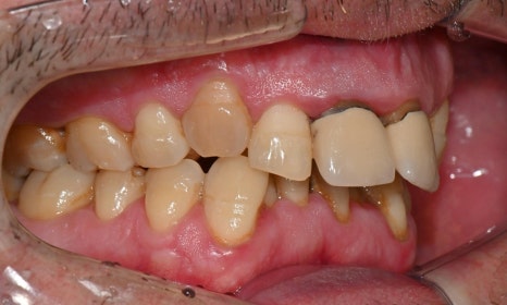 과개교합과 손상된 앞니, 심미와 기능을 함께 회복한 앞니 심미보철 케이스 관련 이미지 4