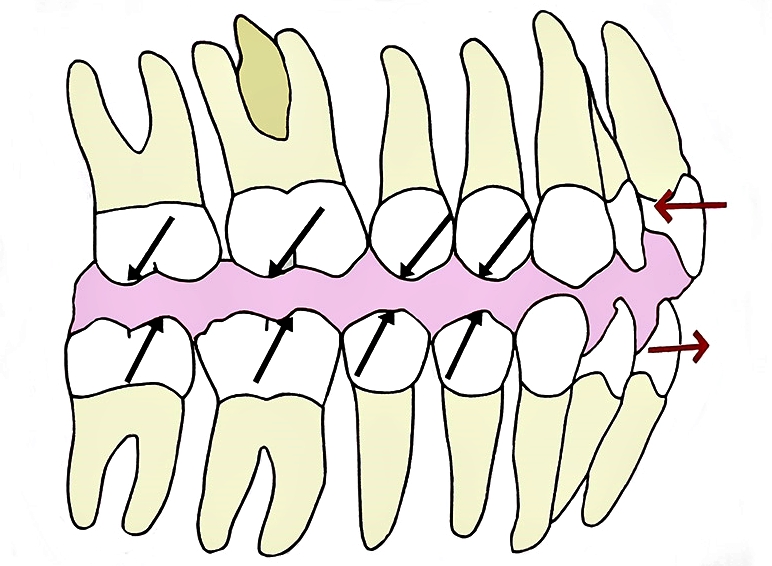 어린이 무턱 액티베이터 성장교정 후 인비절라인 퍼스트 관련 이미지 2