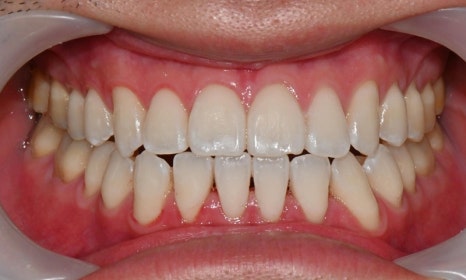 교정 치료 후 치아 미백 관련 이미지 3