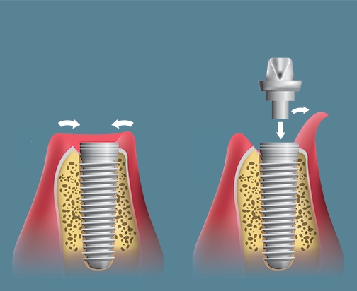 임플란트 1차 수술 vs 2차 수술 관련 이미지 6