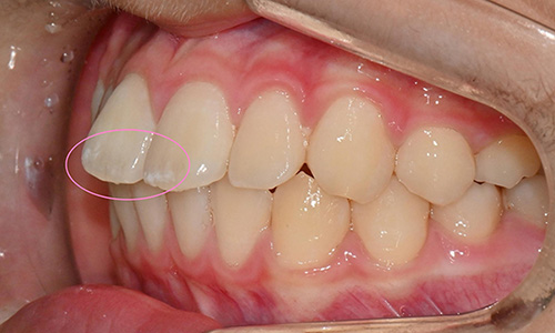 White Spot on My Front Tooth: Cavity or White Spot Lesion? 관련 이미지 2