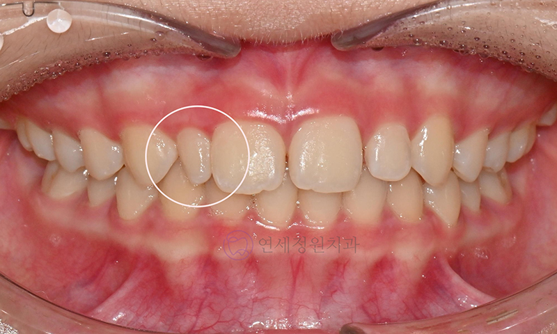 왜소치 치료 - 라미네이트 vs 레진비니어 vs 치아교정 관련 이미지 2