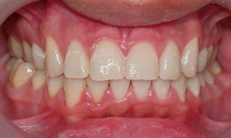 Teeth Whitening After Orthodontic Treatment at Yonsei JW Dental Clinic image 8