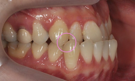 비대칭 및 돌출입 치아교정, 대치동 교정치과 연세정원치과 관련 이미지 2