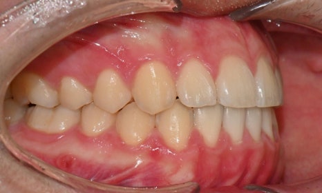 치아 중심선 비대칭과 아랫입술 돌출 개선 관련 이미지 19