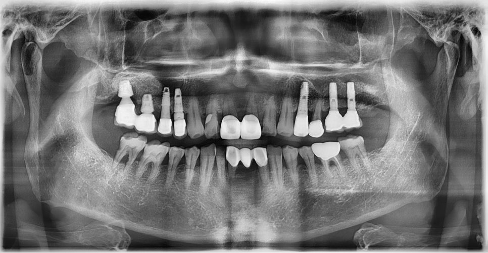 임플란트와 고혈압, 당뇨, 골다공증 등의 전신질환 관련 이미지 5