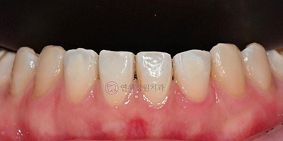 ICON Resin Treatment: White Spots on Front Teeth - Are They Cavities? 관련 이미지 8