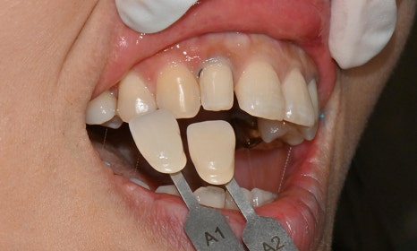 왜소치 치료 - 라미네이트 vs 레진비니어 vs 치아교정 관련 이미지 16