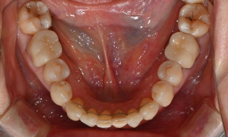 대치동 치경부 레진 & 중년교정 & 치아미백으로 자연스러운 미소를! 관련 이미지 18