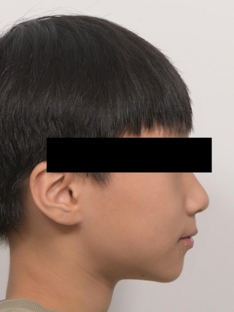 어린이 무턱 액티베이터 성장교정 후 인비절라인 퍼스트 관련 이미지 10