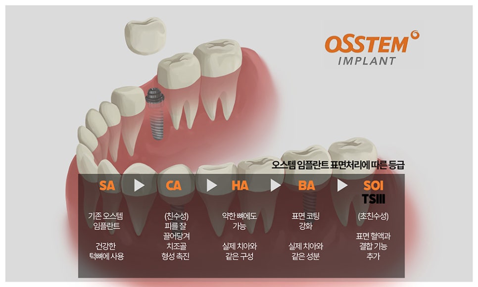 대치동 연세정원치과, 치과 임플란트 종류 및 비용 안내 관련 이미지 4