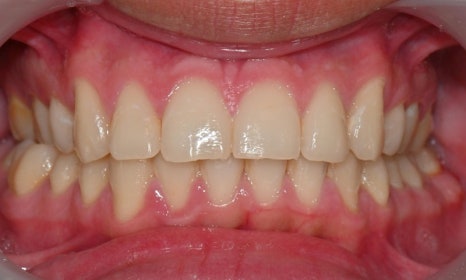 교정 치료 후 치아 미백 관련 이미지 7