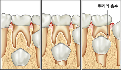 유치 안쪽에서 치아가 올라와요! (대치동 소아치과 연세정원치과) 관련 이미지 3