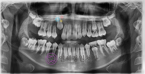 소아교정의 중요성 : 적절한 시기에 유치를 빼주는 것이 중요한 이유 @ 대치동 교정치과 연세정원치과 관련 이미지 8