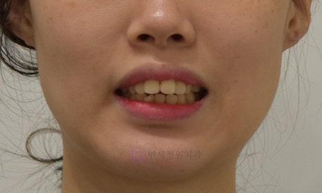 앞니가 안 물려요! 개방교합(openbite) 치아교정 전후 및 후기 관련 이미지 6