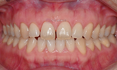 Front Tooth Resin Treatment in Korea: Microdontia, Gaps & Black Triangles 관련 이미지 3