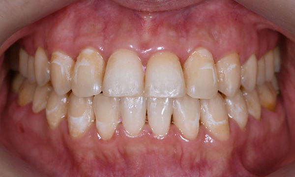 교정치료 후 생긴 치아 하얀 점, 반점치도 아이콘 치료로! @ 대치동 교정치과 연세정원치과의원 관련 이미지 2