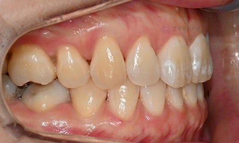 White Spot on My Front Tooth: Cavity or White Spot Lesion? 관련 이미지 4