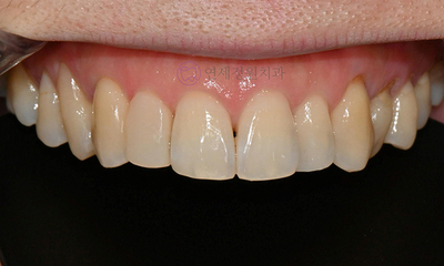 왜소치 치료 - 라미네이트 vs 레진비니어 vs 치아교정 관련 이미지 7