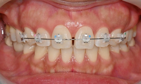 앞니 벌어짐 부분교정 (재교정) 관련 이미지 4