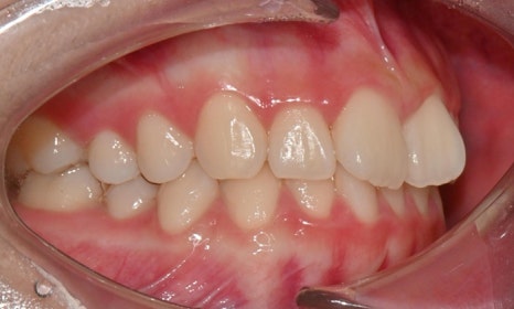 고등학생 인비절라인 교정｜앞니 치아배열 &middot; 과개교합 관련 이미지 3