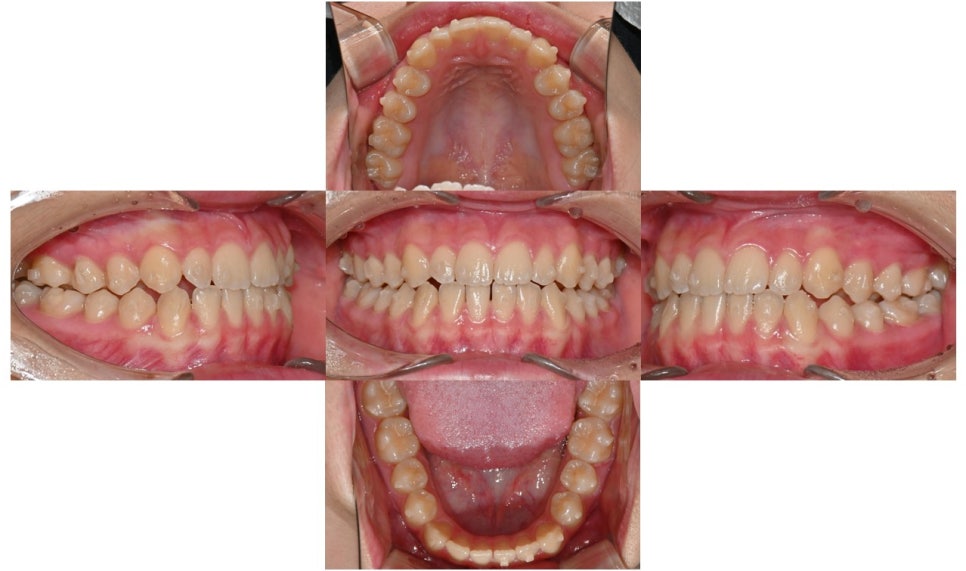 어린이 주걱턱, 페이스 마스크 성장교정 후 인비절라인 관련 이미지 7