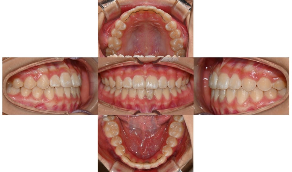 Why Is a Second Phase of Orthodontic Treatment Needed After the First? – A Case of Invisalign Treatment for a Growing Patient with Anterior Crossbite image 9