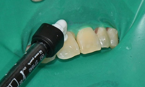 White Spot on My Front Tooth: Cavity or White Spot Lesion? 관련 이미지 8