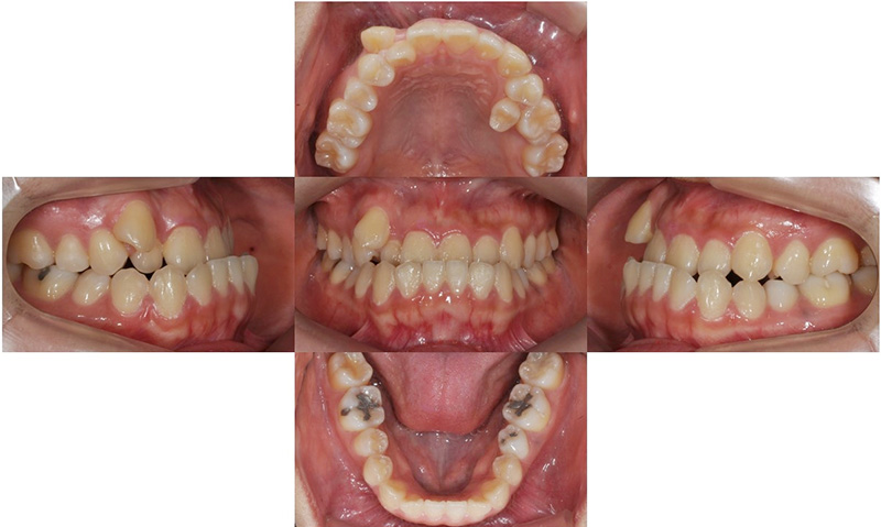 비수술 주걱턱 교정, 대치동 교정치과 연세정원치과 관련 이미지 2