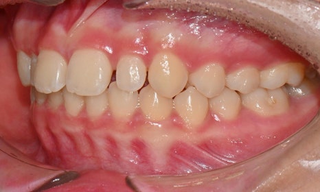 왜소치 치료 - 라미네이트 vs 레진비니어 vs 치아교정 관련 이미지 24