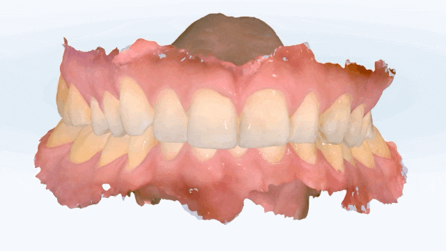 무삭제 라미네이트 vs 인비절라인 익스프레스 관련 이미지 5