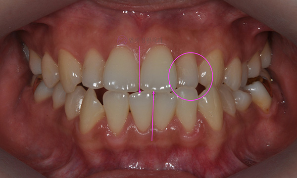 치아 중심선이 안 맞아요! 치아 비대칭 교정으로 가능할까요? @ 대치동 교정치과 연세정원치과 관련 이미지 18