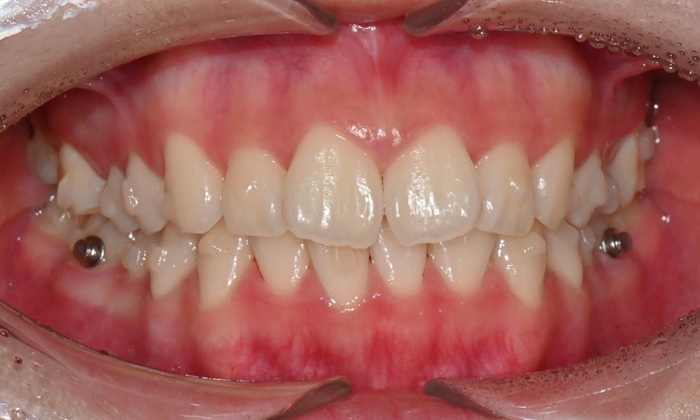 고등학생 인비절라인 교정｜앞니 치아배열 &middot; 과개교합 관련 이미지 7