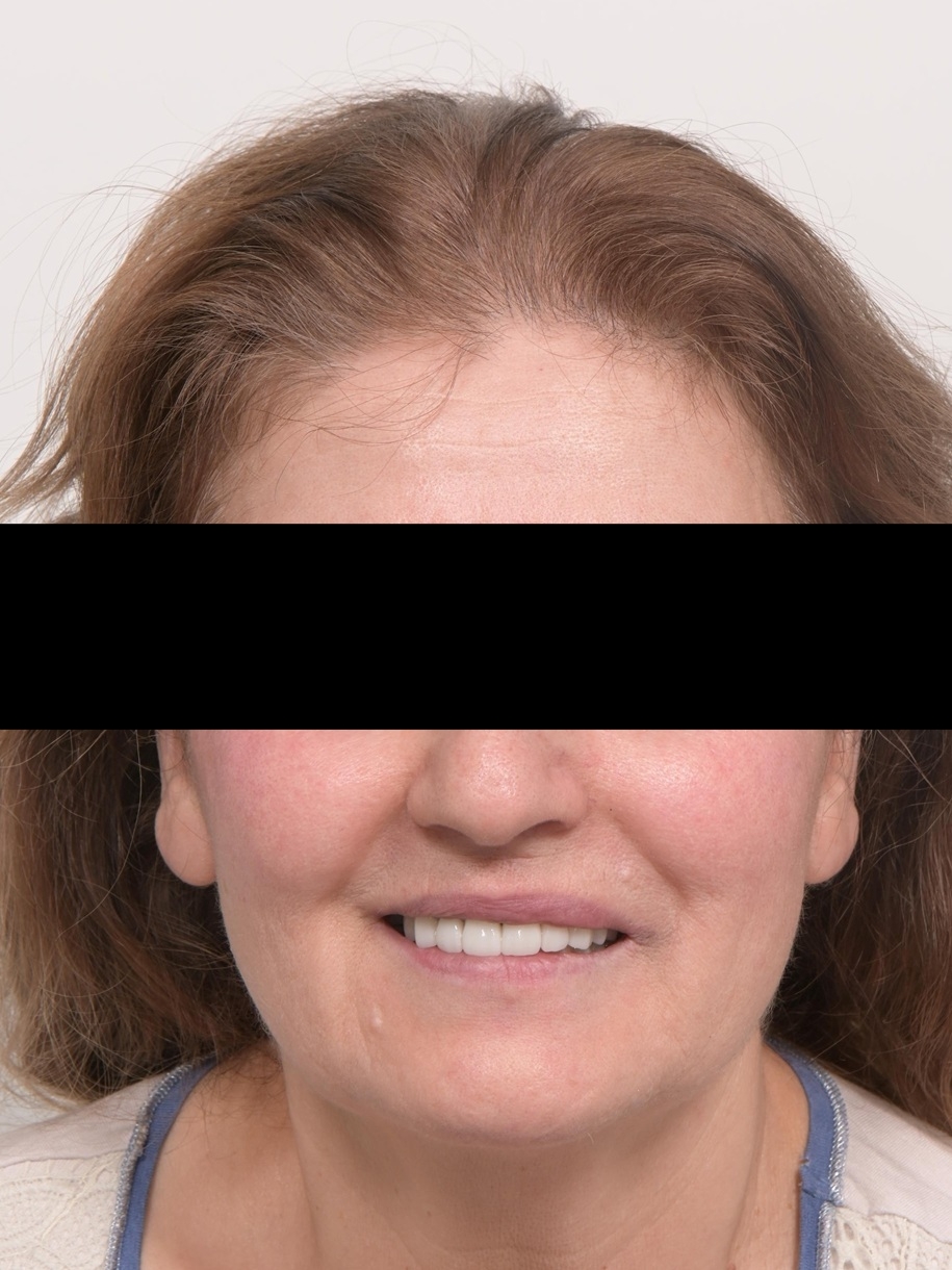 심미와 기능을 모두 고려한 앞니 심미보철 재치료 관련 이미지 11