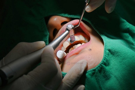 원데이 치아미백의 순서 @ 대치동 치아미백 연세정원치과의원 관련 이미지 3