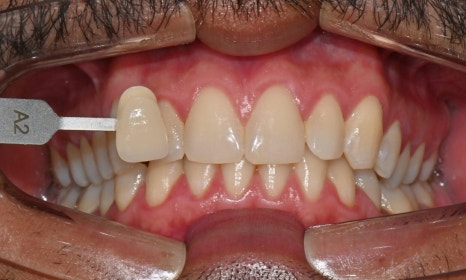Invisalign Transfers for Immigration, Studying Abroad, Relocation, and More — International Students and Military Personnel image 6