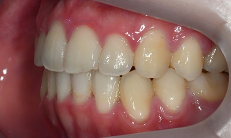 비대칭 및 돌출입 치아교정, 대치동 교정치과 연세정원치과 관련 이미지 18