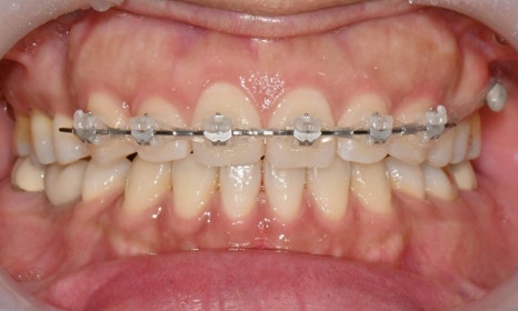 인비절라인 익스프레스 부분교정 <앞니 재교정> 관련 이미지 2