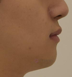 비대칭 및 돌출입 치아교정, 대치동 교정치과 연세정원치과 관련 이미지 13