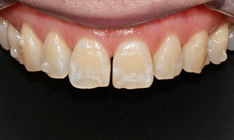 White Spot on My Front Tooth: Cavity or White Spot Lesion? 관련 이미지 9