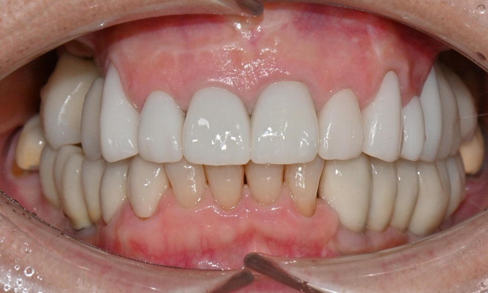 심미와 기능을 모두 고려한 앞니 심미보철 재치료 관련 이미지 8