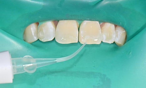 White Spot on My Front Tooth: Cavity or White Spot Lesion? 관련 이미지 7