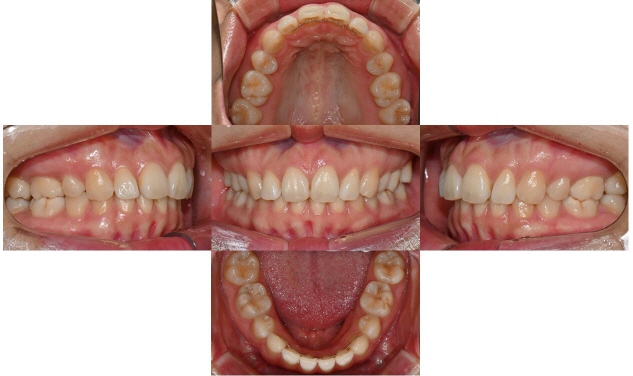 인비절라인 익스프레스 부분교정 <앞니 재교정> 관련 이미지 4