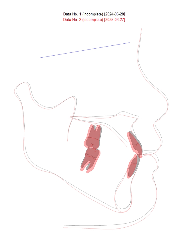 어린이 주걱턱, 페이스 마스크 성장교정 후 인비절라인 관련 이미지 10
