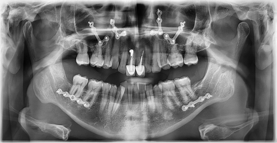 과개교합과 손상된 앞니, 심미와 기능을 함께 회복한 앞니 심미보철 케이스 관련 이미지 2
