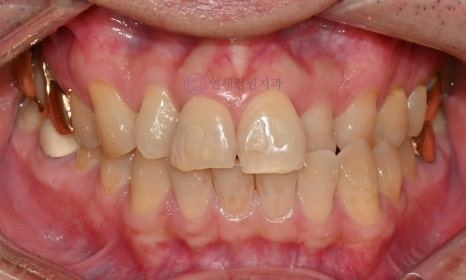 Precautions for Teeth Whitening Treatment @ Yonsei JW Dental Clinic 관련 이미지 6