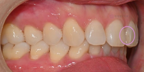 앞니 심미 레진 치료 : 블랙트라이앵글, 앞니 사이 공간 @ 대치동 연세정원치과 관련 이미지 10