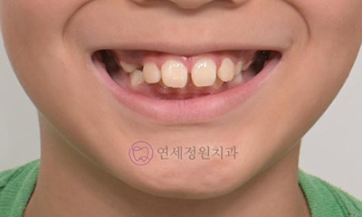 대치동교정치과, 무턱 성장교정과 엑티베이터 관련 이미지 3