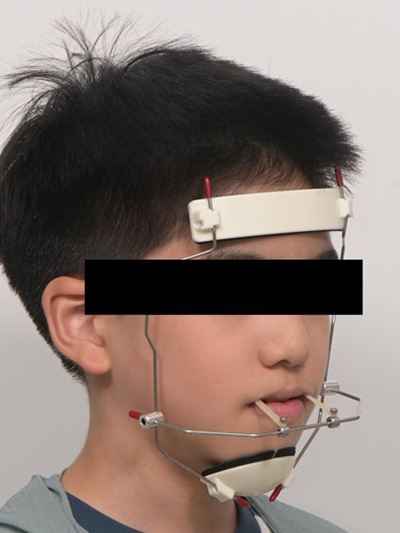 주걱턱, 커가면서 저절로 좋아질까요? 부모가 놓치기 쉬운 신호 관련 이미지 5