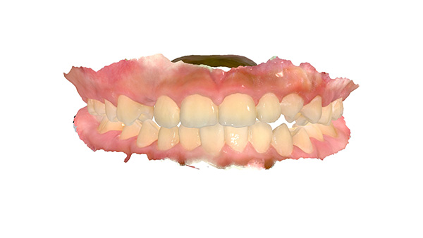 아이들이 더 좋아하는 인비절라인 퍼스트 @ 대치동 교정치과 연세정원치과 관련 이미지 2